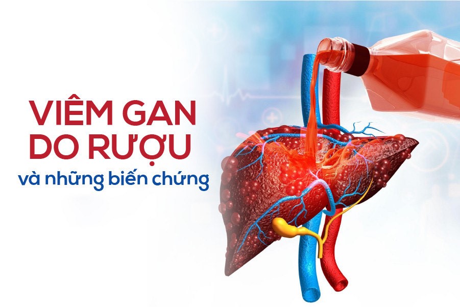 Viêm gan do rượu