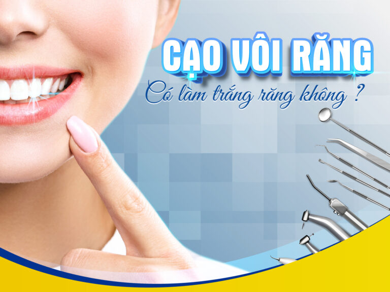 Lời Khuyên Từ Bác Sĩ Nha Khoa Về Cạo Vôi Răng